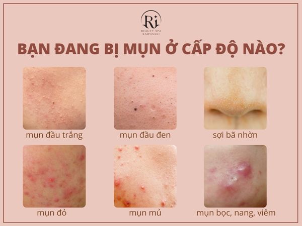 Kem dưỡng ẩm cho da dầu mụn