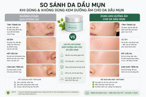 Kem Dưỡng Ẩm Cho Da Dầu Mụn