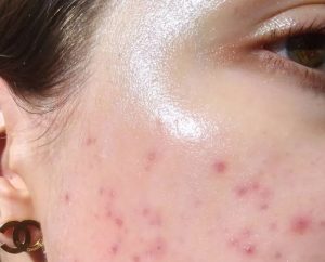 Kem Dưỡng Ẩm Cho Da Dầu Mụn